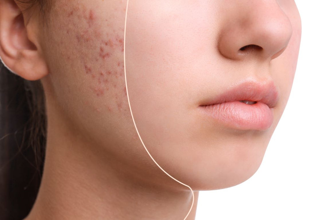 Top 5 Acne Treatments Worth Exploring: A Deep Dive into Effective Products