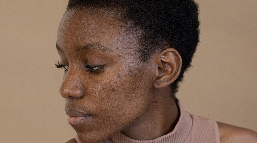 Best Serums for Hyperpigmentation