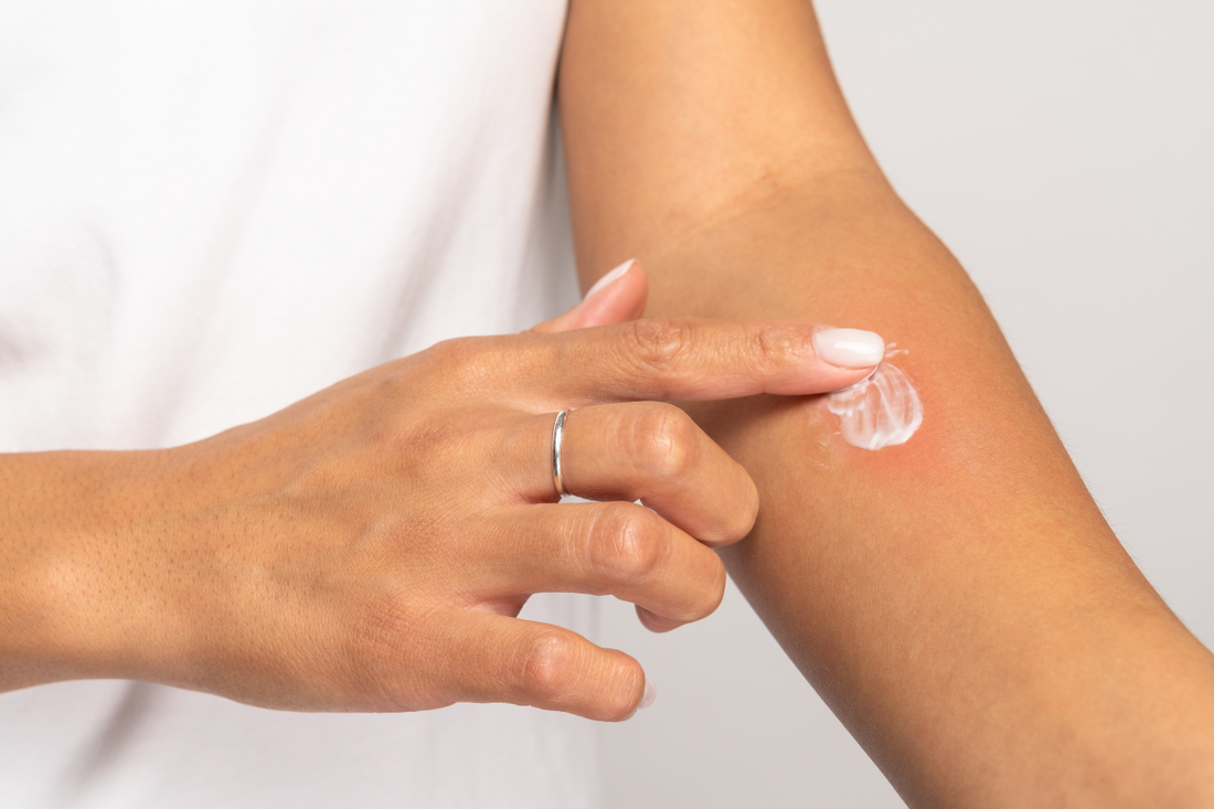 Use This, Not That: Best & Worst Skincare for Eczema Relief