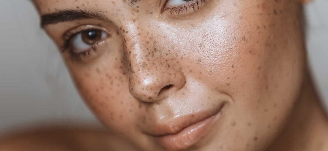 Combatting Hyperpigmentation
