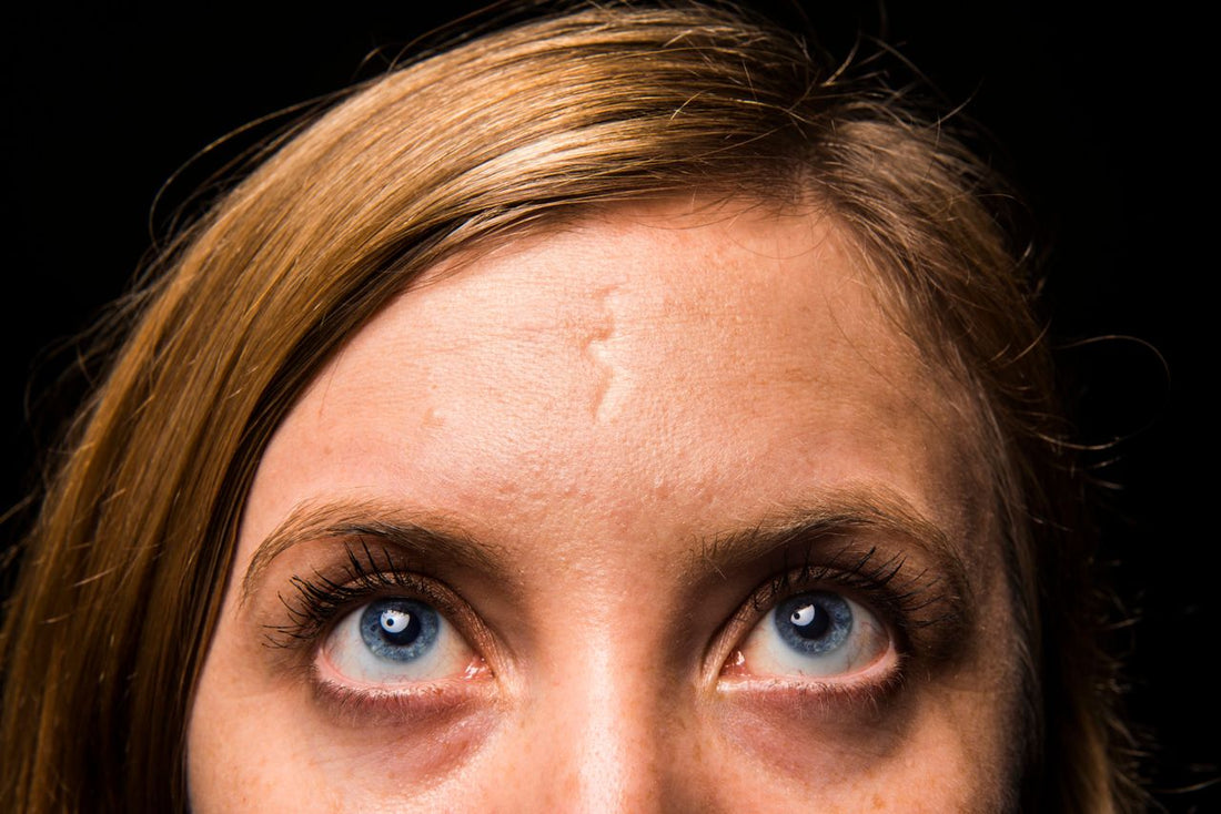 Scar Removal Products