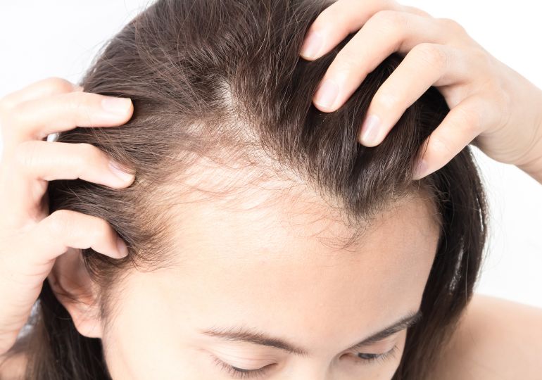 Hair Loss from Weight Loss Medications: How to Manage Thinning Hair with Ozempic