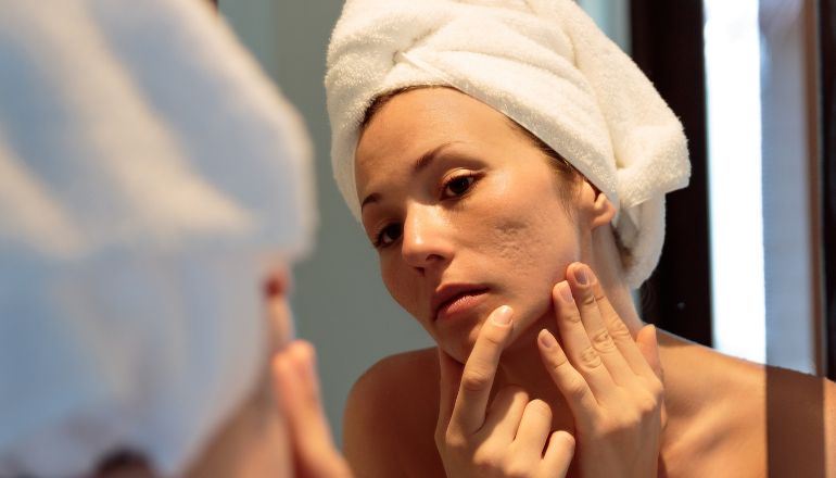 ACNE Face Mapping – What is Your Acne Trying to Tell You?