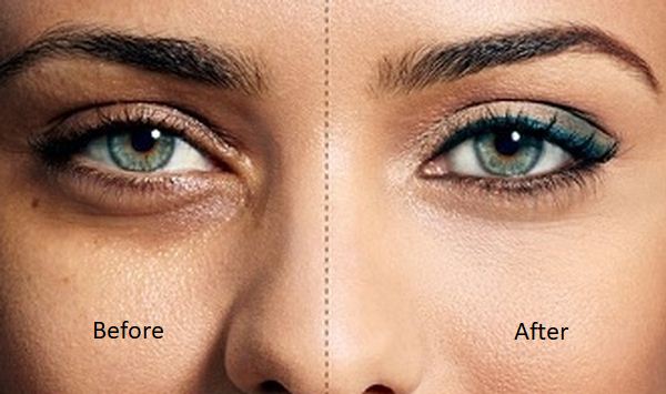 How to Get Rid of Dark Circles Under the Eyes