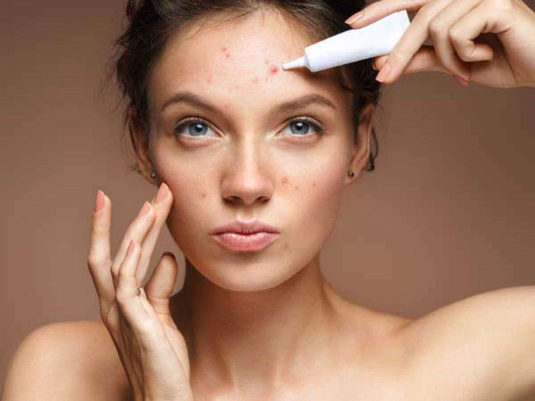 How to Use Retinols to Treat Acne