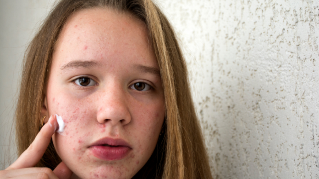 Teen Acne – How to Help Your Teen Manage Acne Breakouts